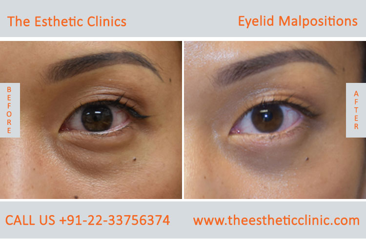 Eyelid Malpostions, Ectropion Entropion Surgery before after photos in mumbai india (2)